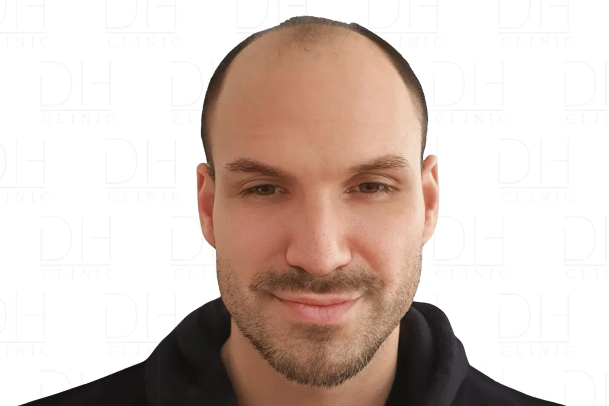 Haartransplantation Vorher FUE Saphir - Patient 3 Dion Hair Clinic