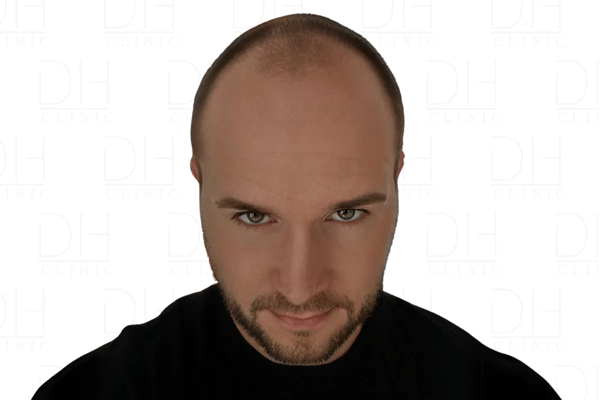 Haartransplantation Vorher DHI Methode - Patient 2 Dion Hair Clinic