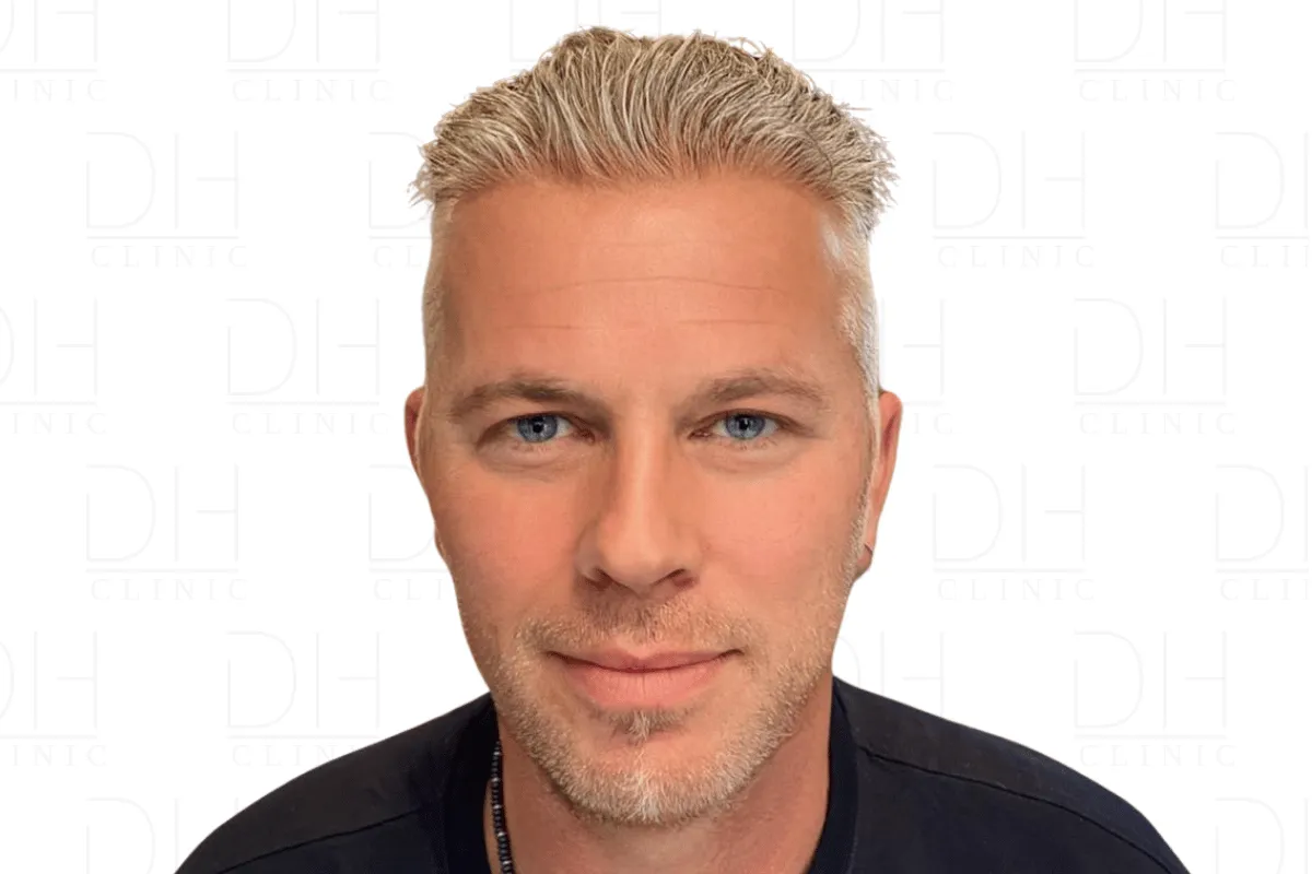 Haartransplantation Nachher Ergebnis 3.500 Grafts - Patient 1 Dion Hair Clinic