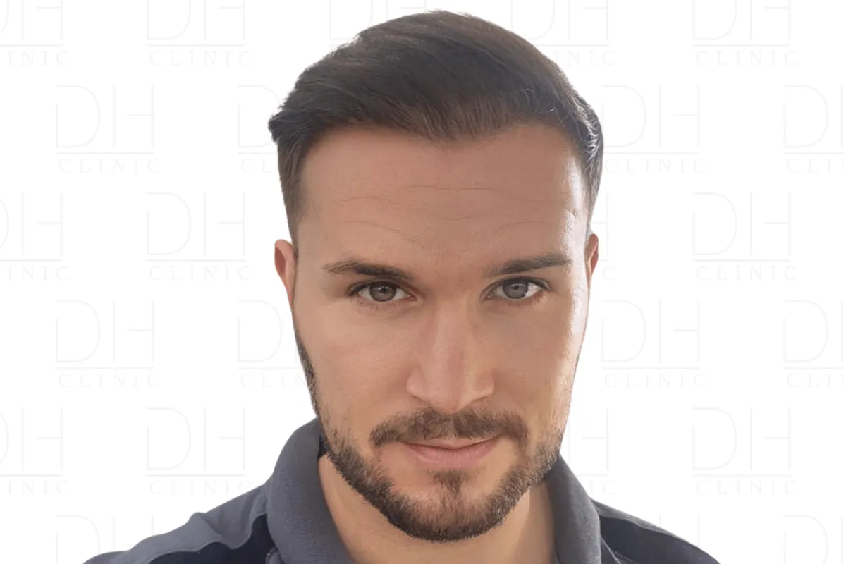 Haartransplantation Nachher Ergebnis 4.200 Grafts - Patient 2 Dion Hair Clinic