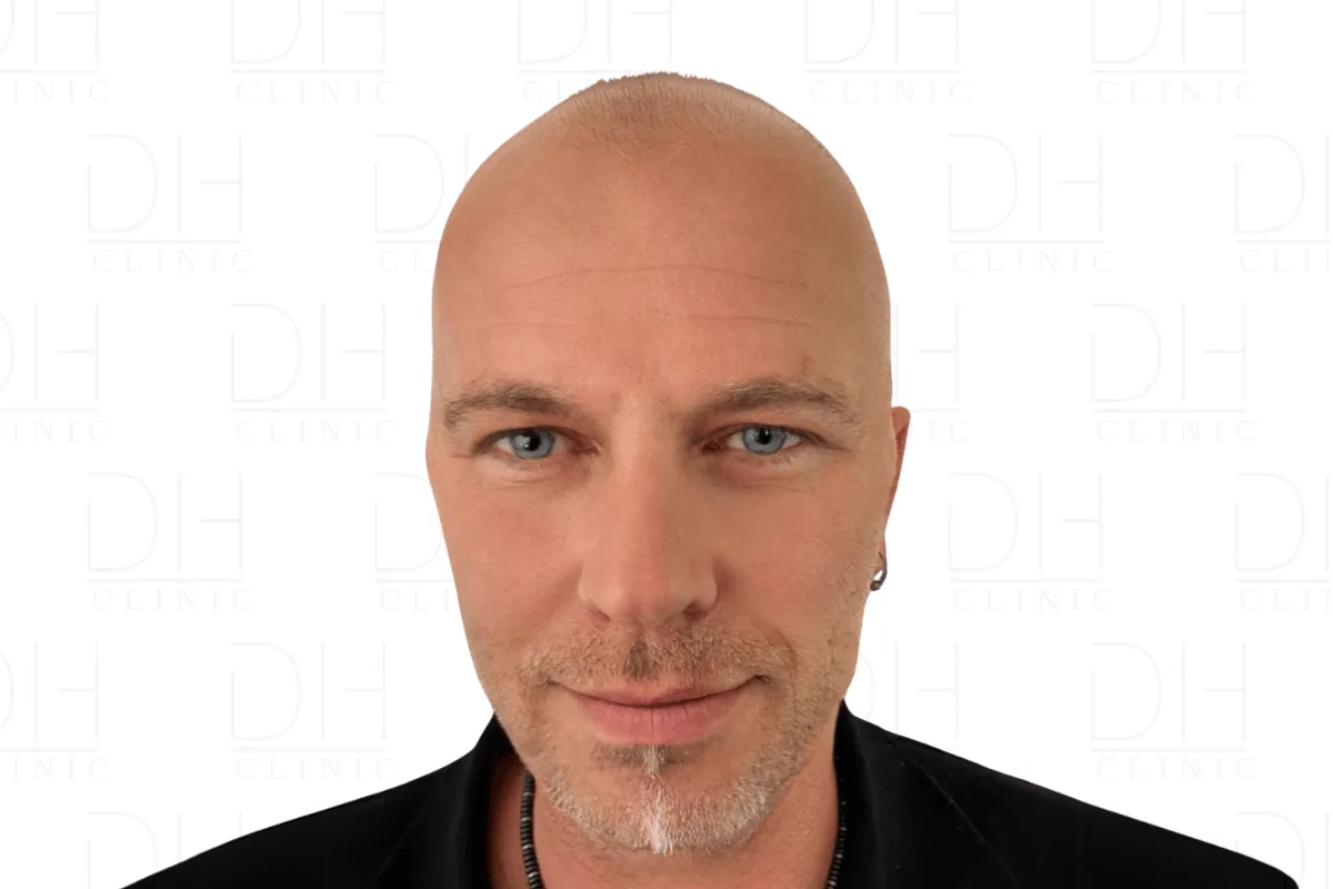 Haartransplantation Vorher FUE Saphir - Patient 1 Dion Hair Clinic