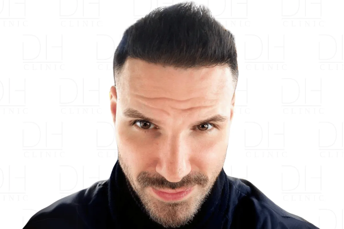 Haartransplantation Nachher Ergebnis 2.800 Grafts - Patient 3 Dion Hair Clinic
