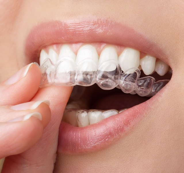 Ortodoncia Invisible — Invisalign