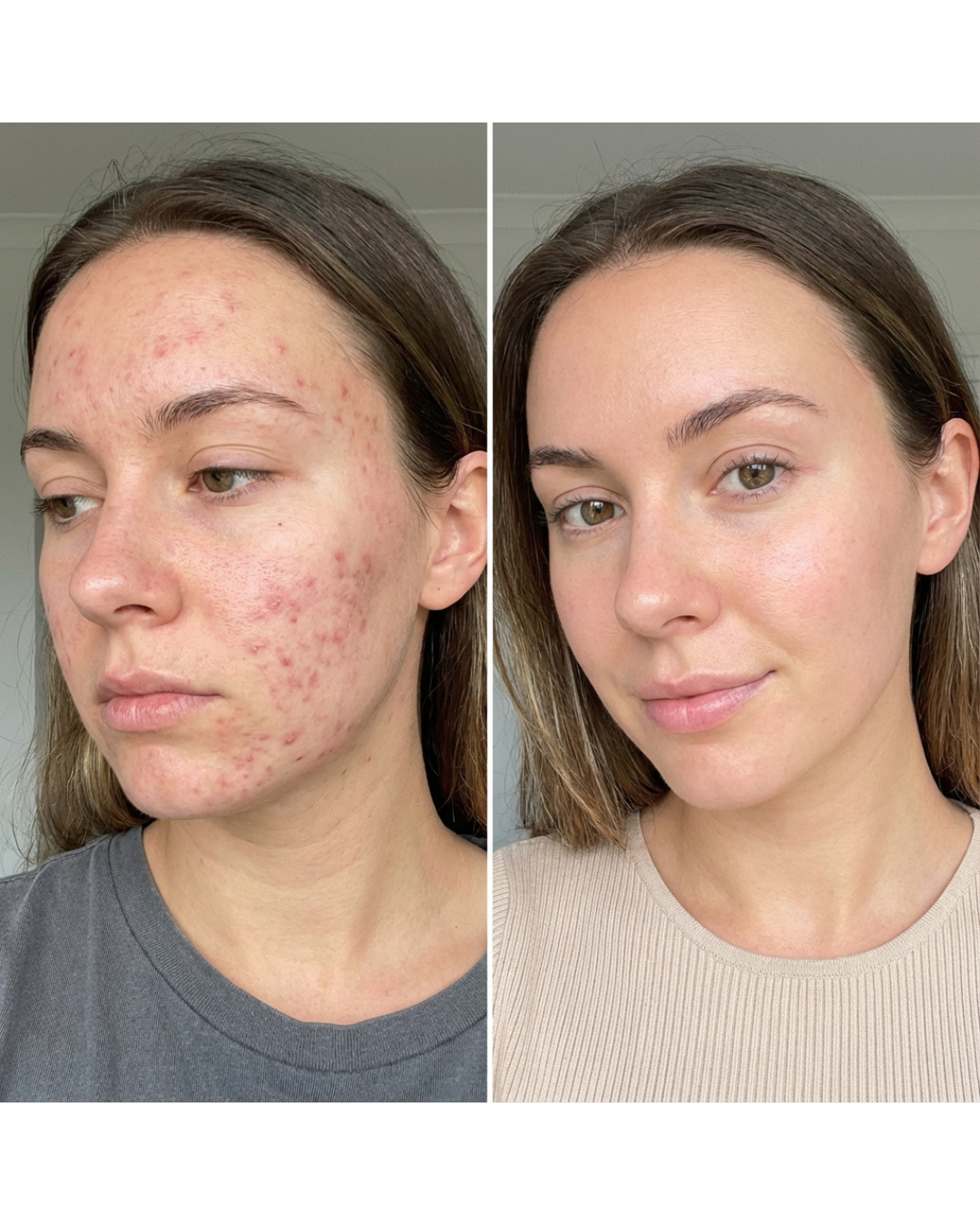 Chloe's results with the Leopard Luxe mask