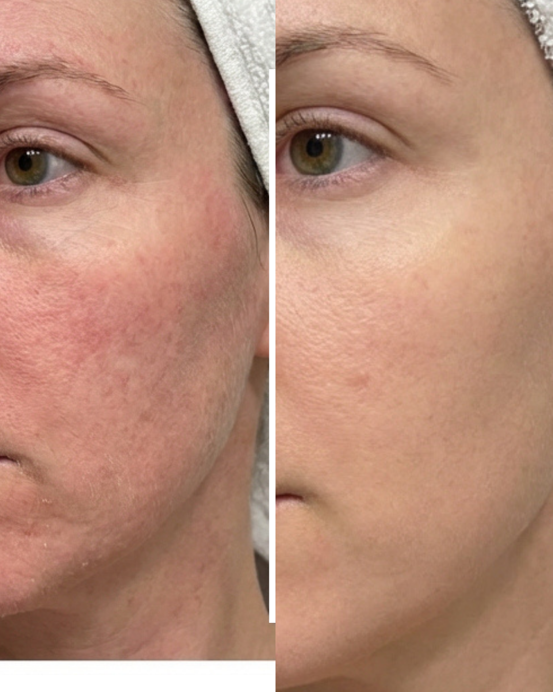 Rachel's results with the Leopard Luxe mask