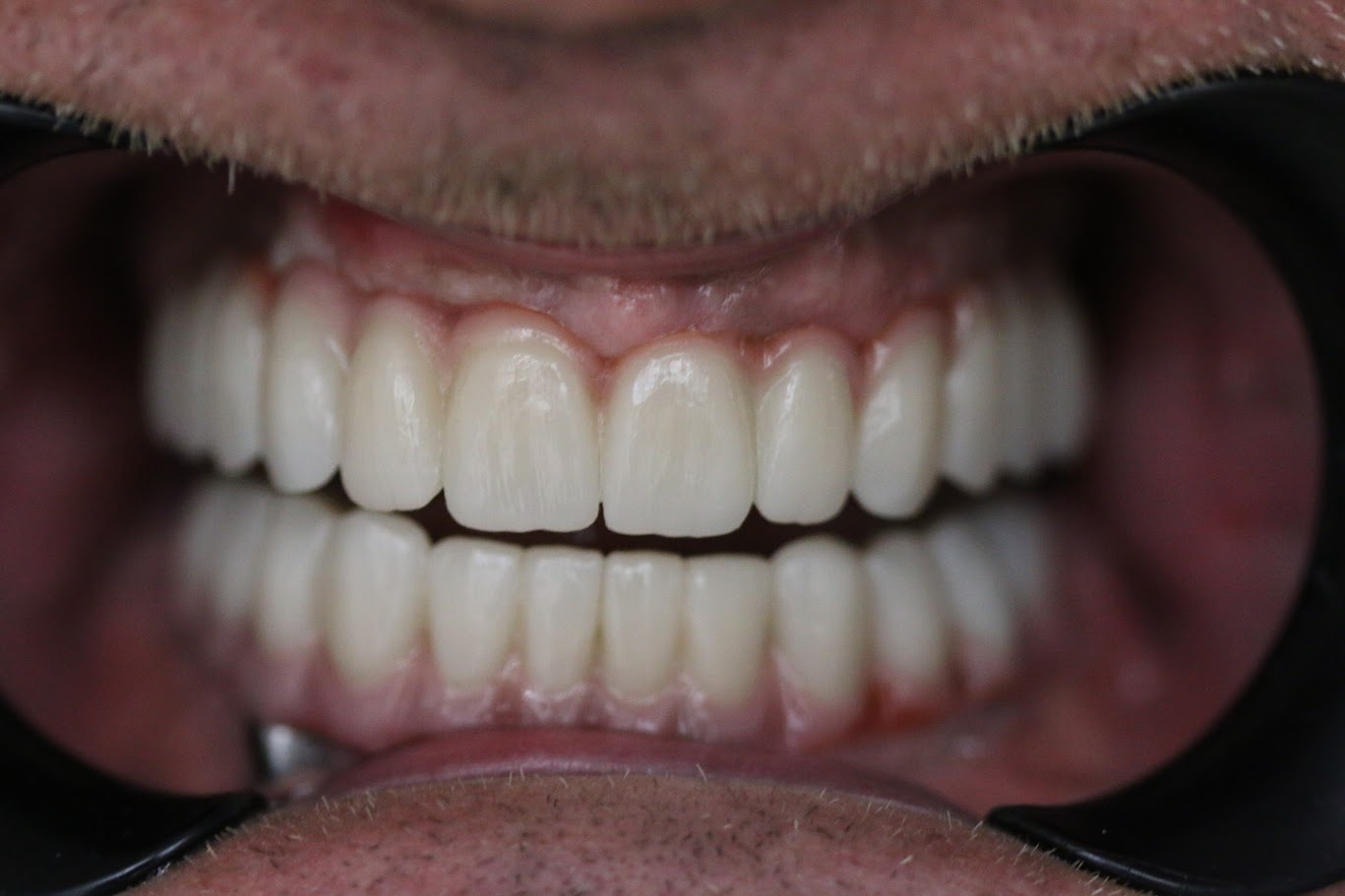 Detalj rada — premium dentalni materijali i precizan zahvat