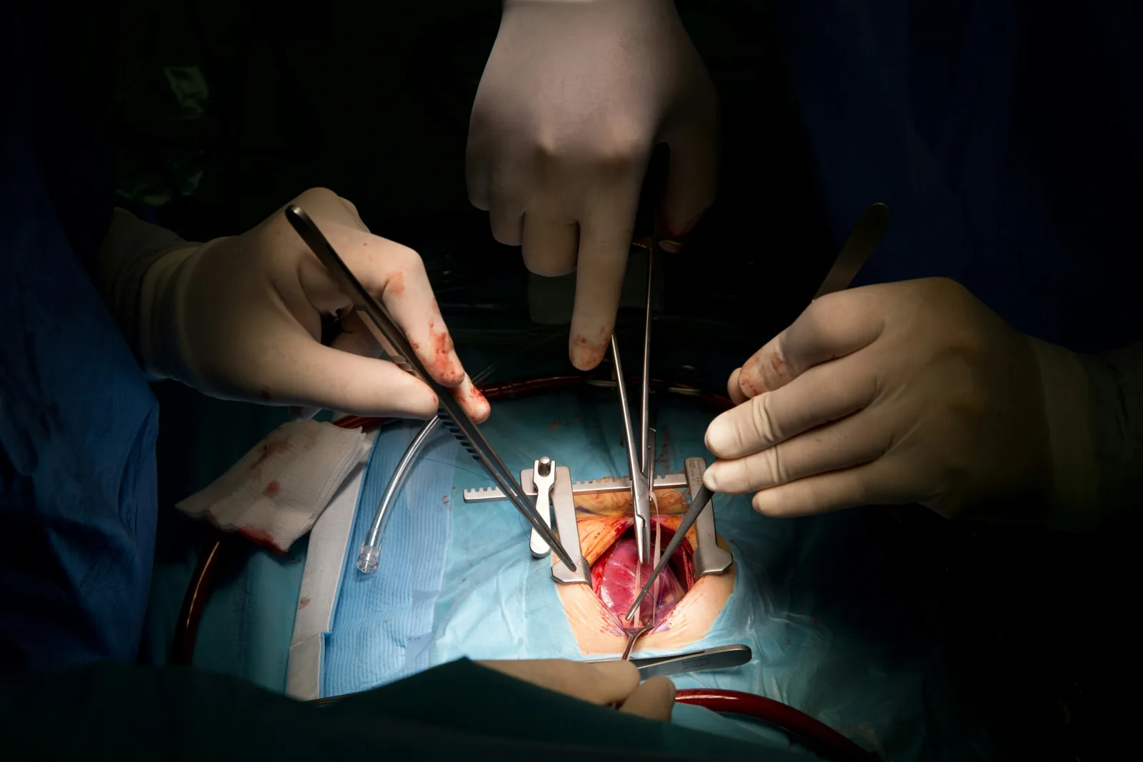 Cardiac Surgery treatment in India — AmanSehat