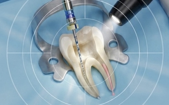 Root Canal Treatment