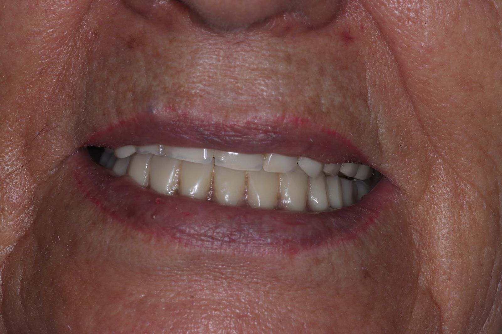 Después - Implantes Dentales