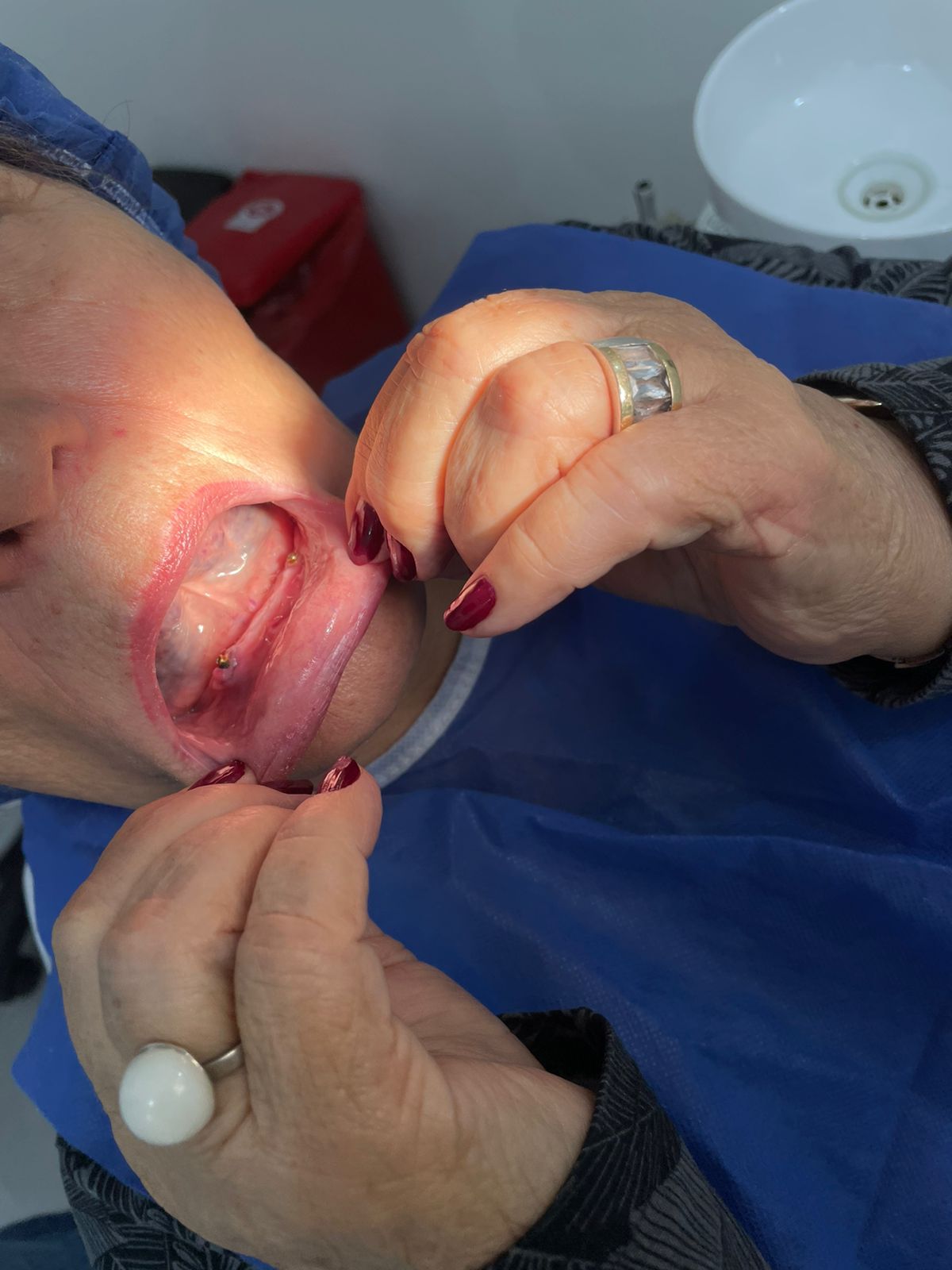 Antes - Implantes Dentales