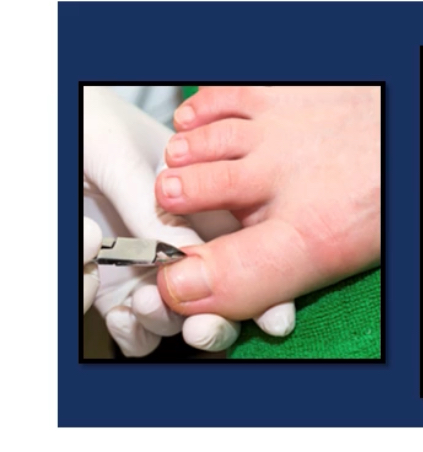 Ingrown Toenail Removal