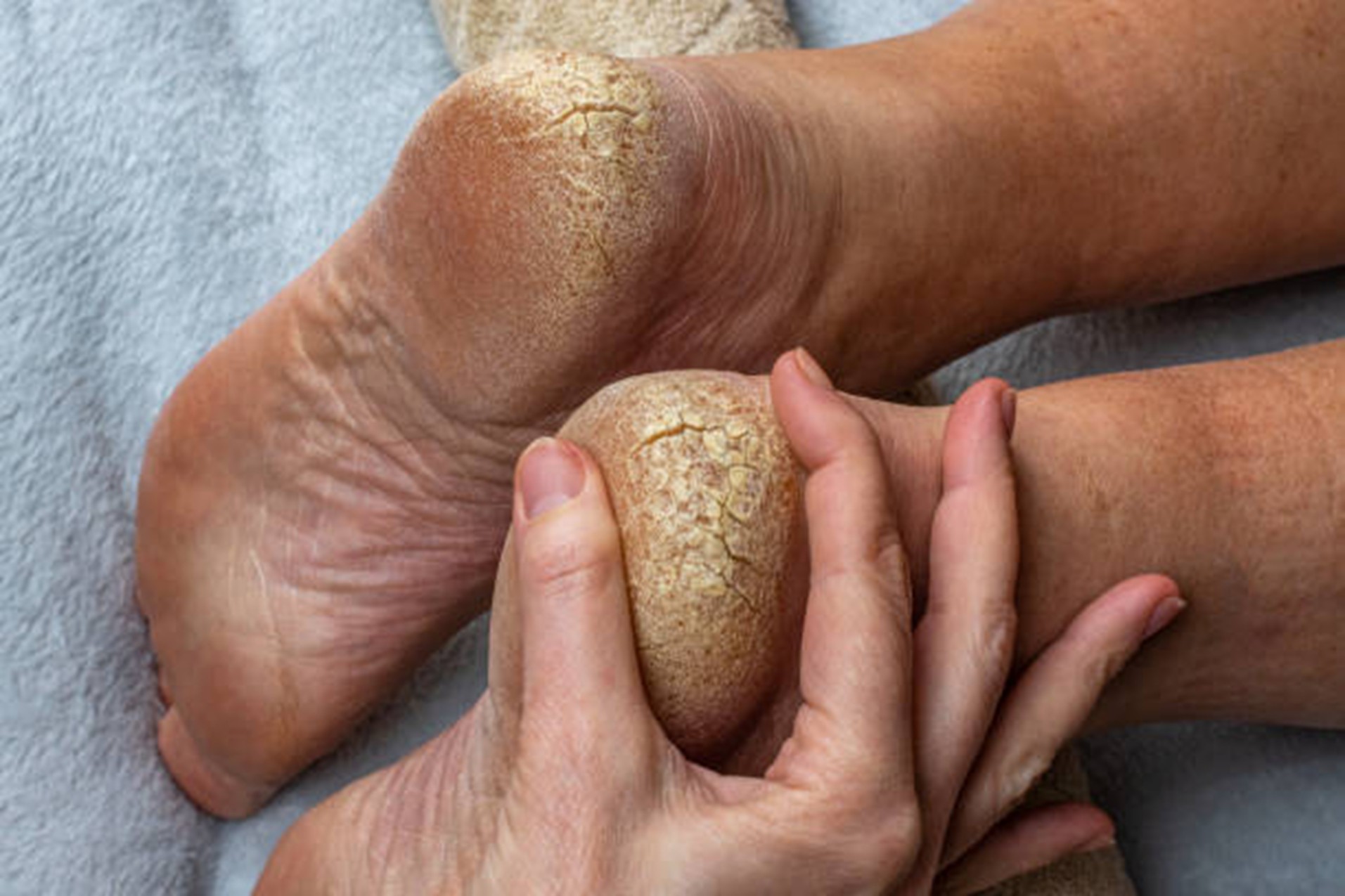 Callus Removal