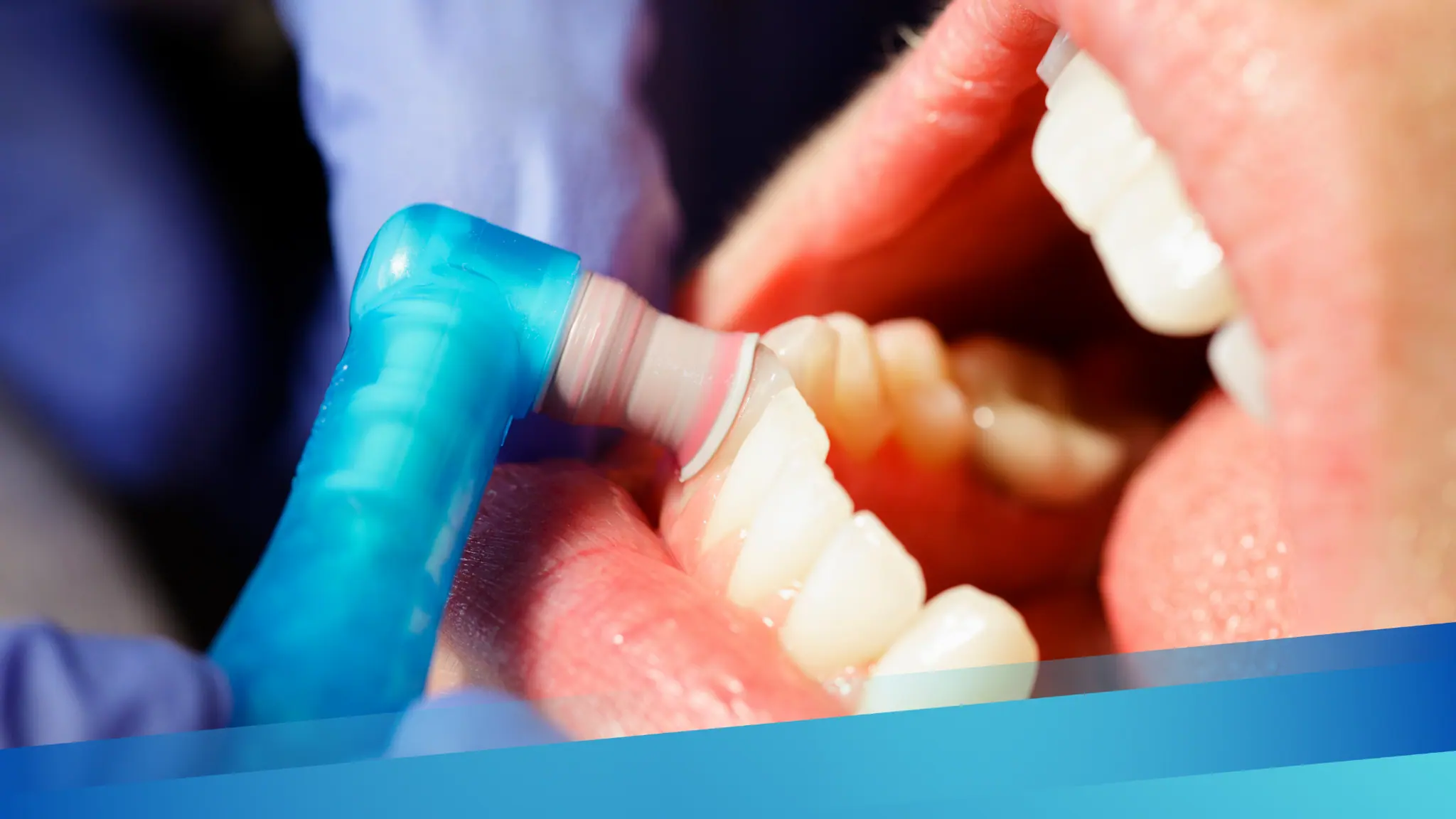 ¿Cuánto Cuesta una Limpieza Dental en El Salvador? Precios 2025