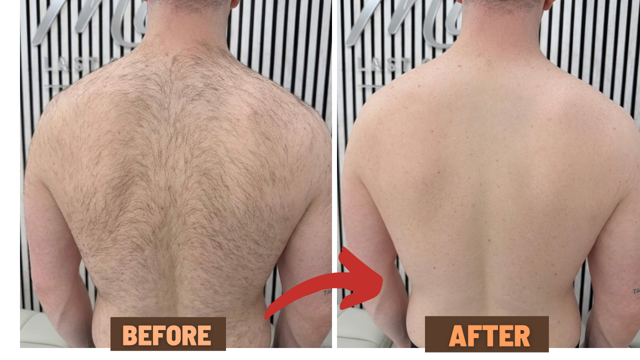 Before and After - Laser Hair Removal Results