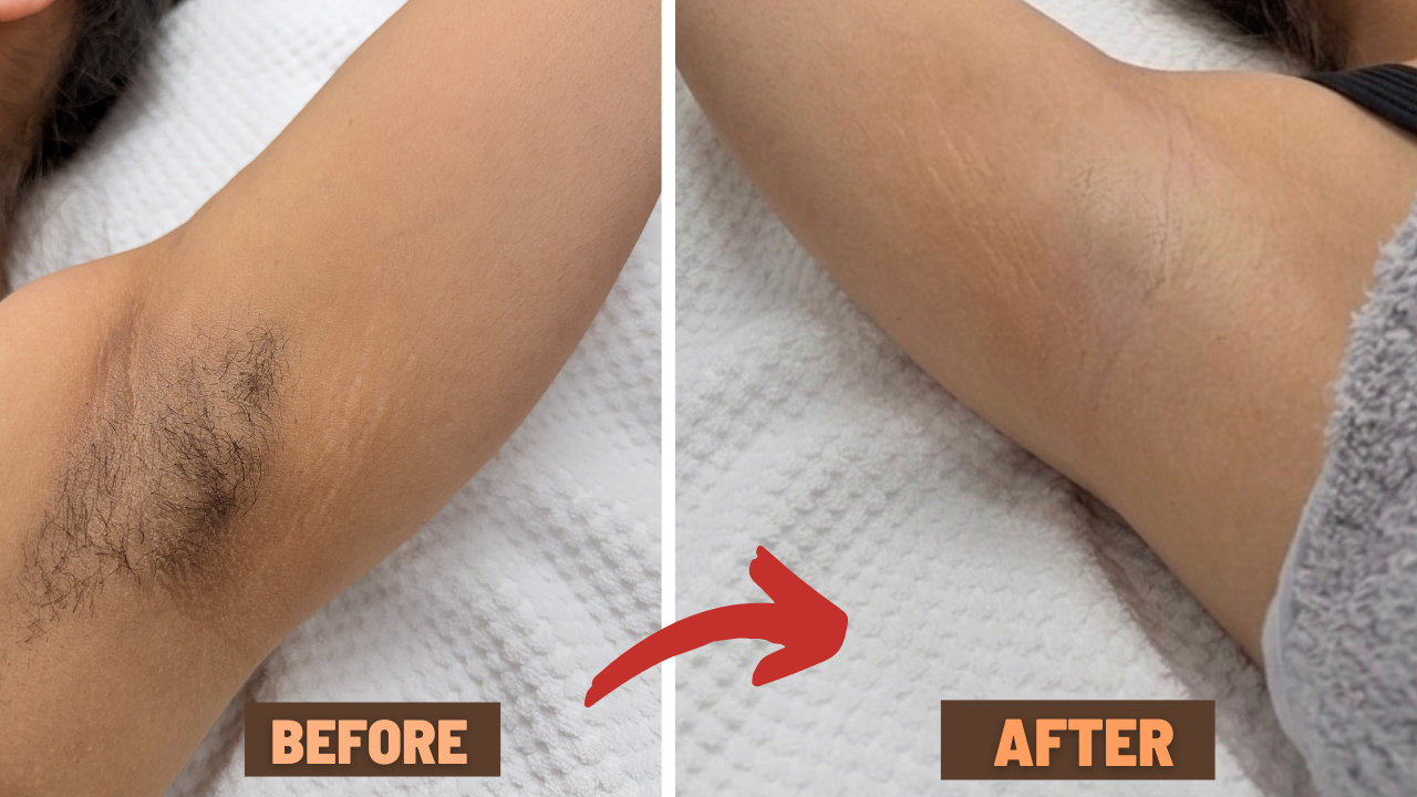 Before and After - Back Hair Removal Results