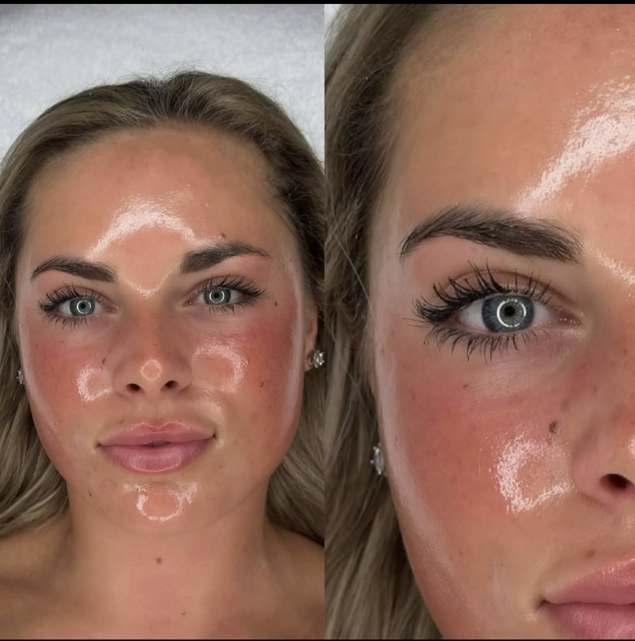 Hydrafacial behandling i detalj – Medskinby Oslo