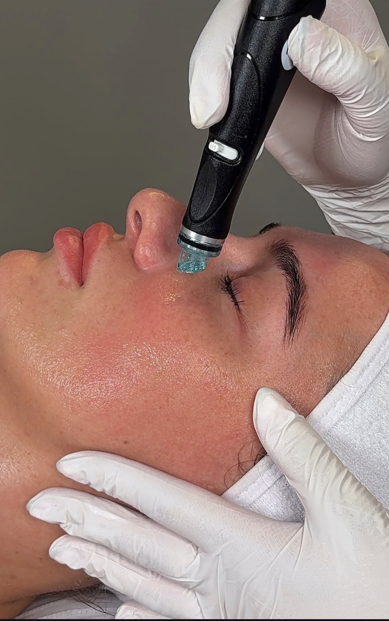 Resultat etter Hydrafacial – glød og jevnere hud