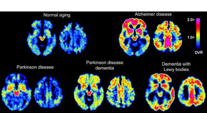 PET brain scans comparing normal aging, Alzheimer's disease, Parkinson's disease, Parkinson's disease dementia, and dementia with Lewy bodies